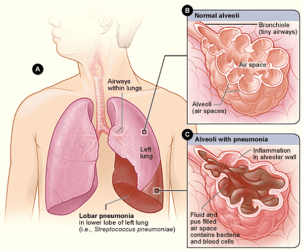 Pulmonary issue:  With pneumonia, the air sacs may fill with fluid or pus.  