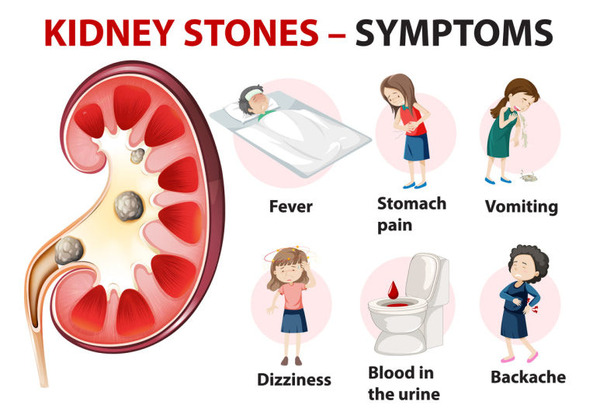 Kidney Stone Symptoms:  THe most common symptom is severe pain, usually on the side of the abdomen.  