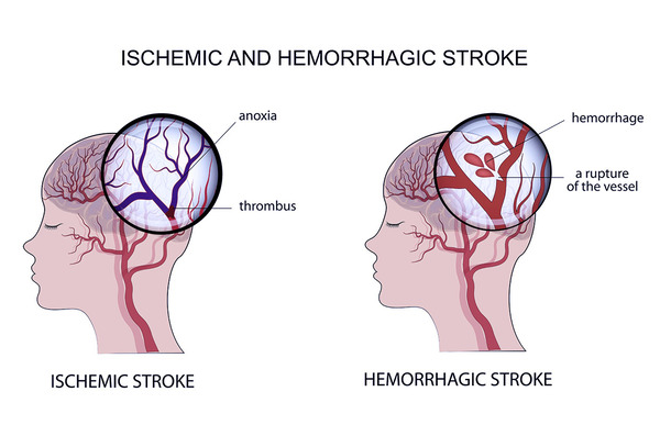 Ischemic Stroke:  There are two different types of stroke; an ischemic strok and a hemorrhagic stroke