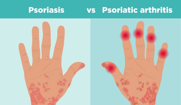 PsA treatment may include topical medications.  