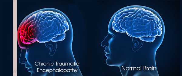 NFL concussionss cn lead to cognitive impairments.  