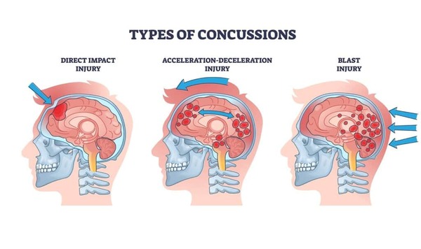 Concussion Awareness:  There are several different types of Head Trauma