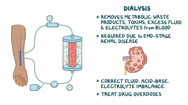 Hemodialysis procedure involves filtering blood outside the body through an artifial kidney machine.  