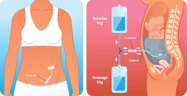 Peritoneal dialysis care is often administered at home. 