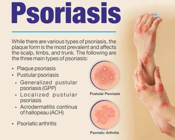 Chronic skin conditions include plaque psoriasis