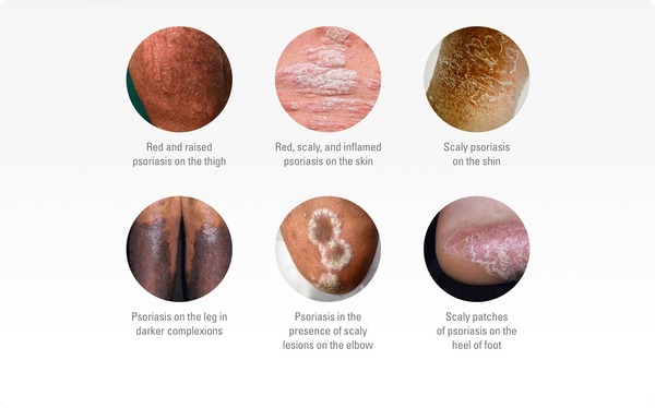 Plaque psoriasis is one of many autoimmune skin disorders in the human body.  