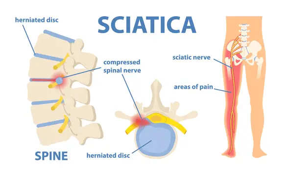 Sciatica Treatment is getting attention with opioid alternatives